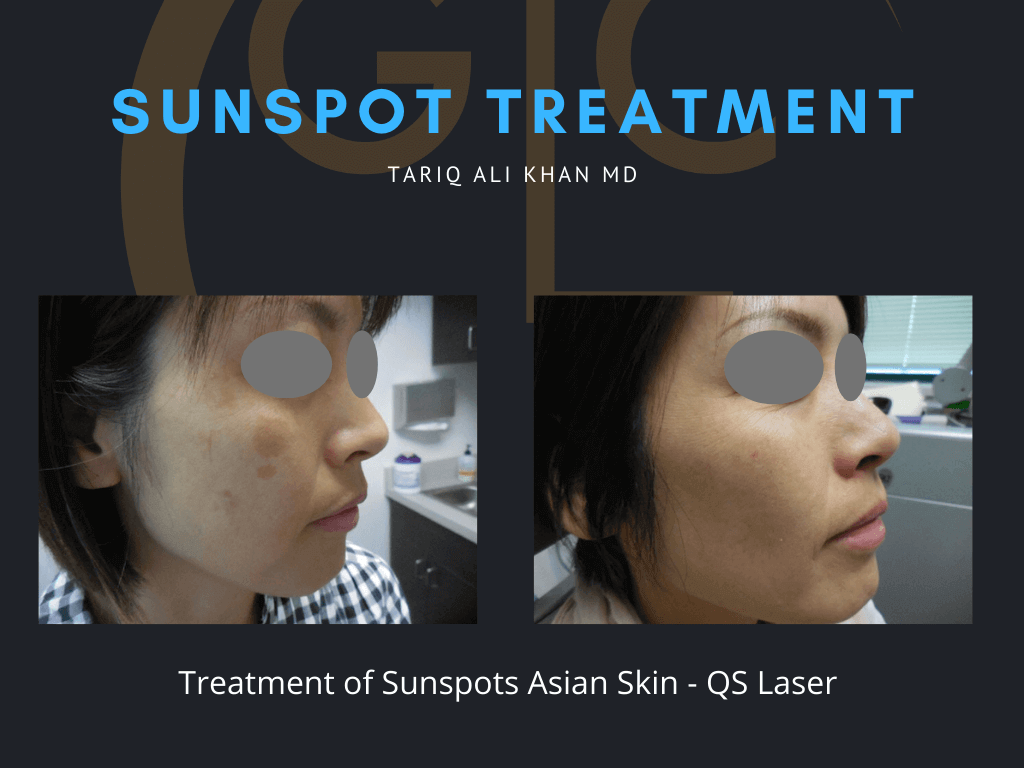 Gentle Care Laser Tustin & Long Beach Before and After picture - Sunspot treatment